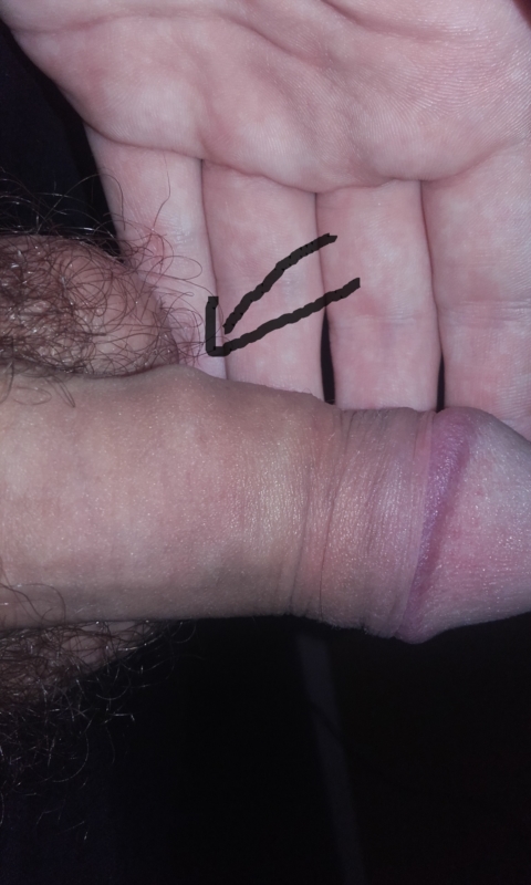 Large Bump On Penis 72
