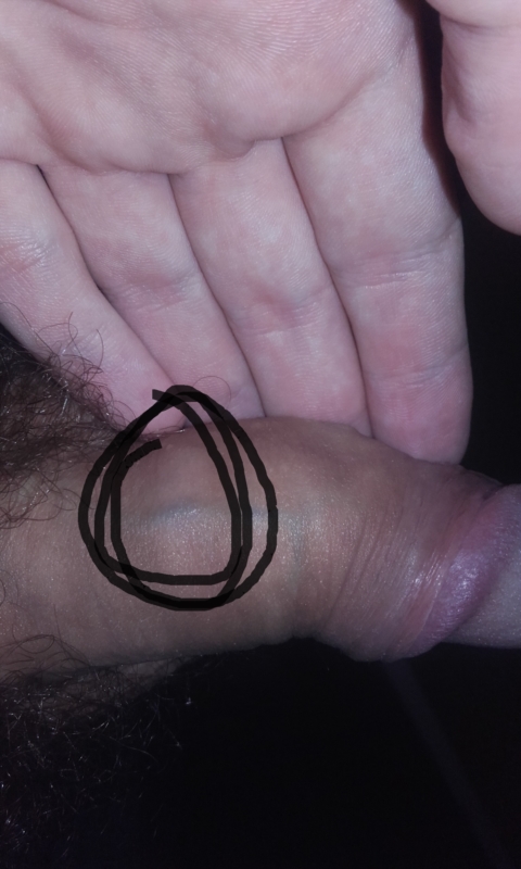 Large Bump On Penis 85