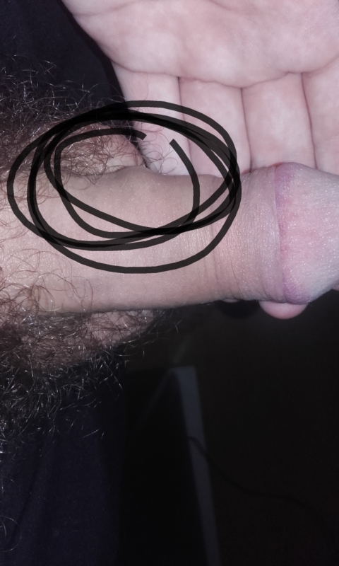 Lump In Penis Shaft 35
