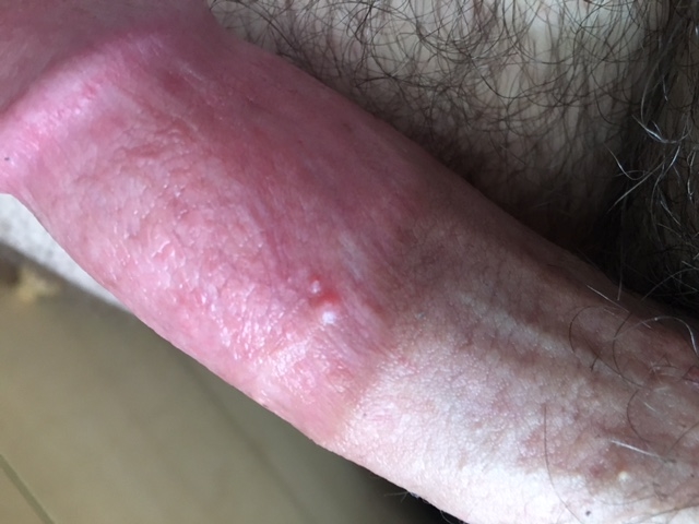 Brown papules on the penis