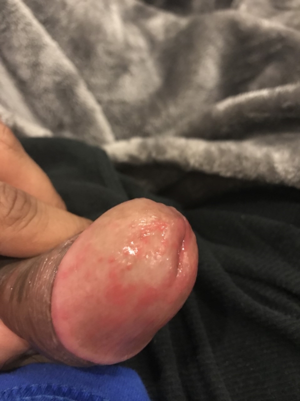 Red Penis After Sex 87