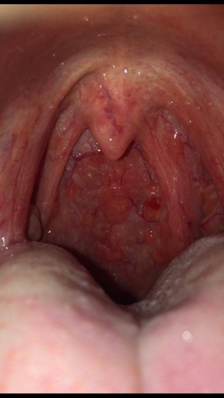 Red Bump Back Of Throat 52