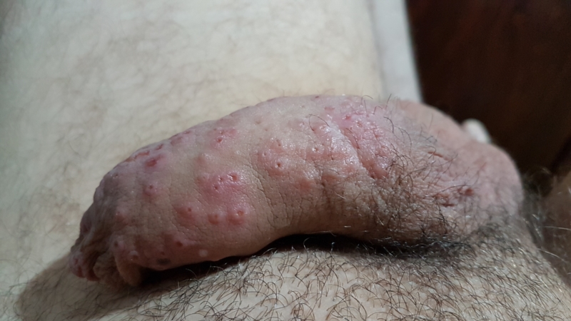 Pimples on penis (that itch and hurt) - Multiplying every day.