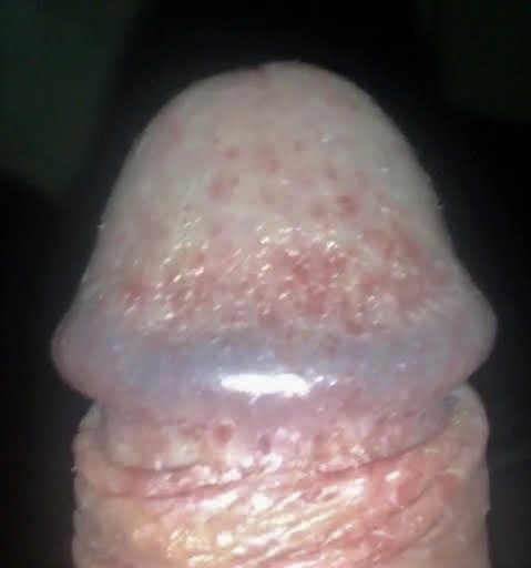 Red Spots On The Head Of My Penis 21