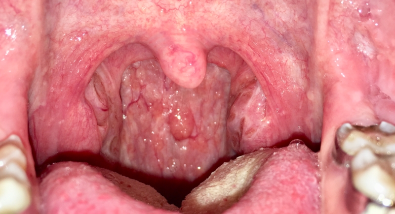 Normal Throat Picture 57
