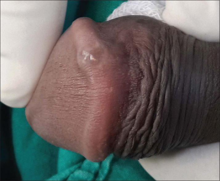 Well Demarcated Erythema Of The Glans Penis
