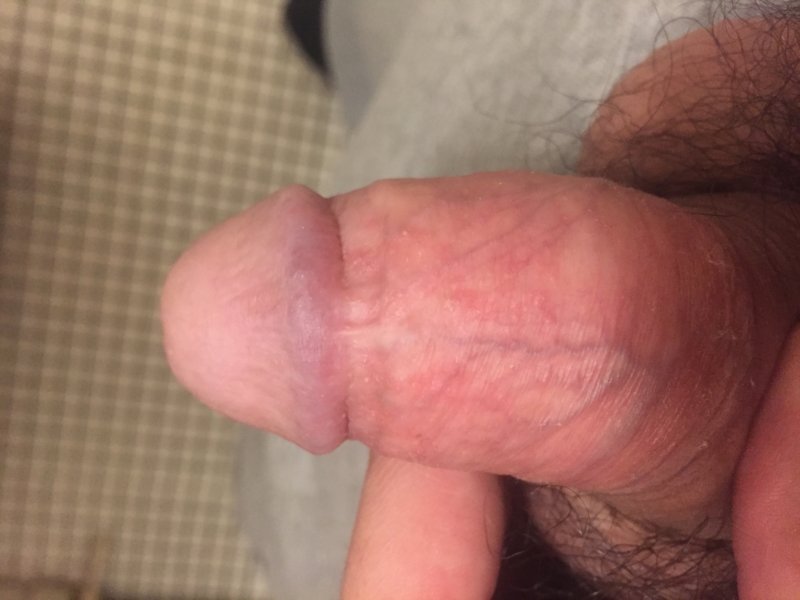little red pimple like dots on penile glans.