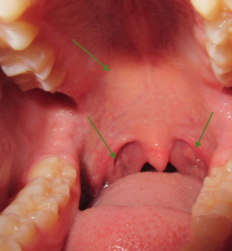 sovjetisk bureau Kig forbi itchy roof of mouth | Page 2 | Allergic Disorders | Forums | Patient