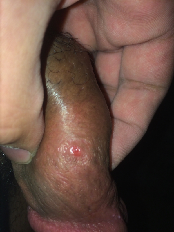 Red Spots on Penis, Foreskin, Shaft, Glans, Itchy, STD, Get Rid, Pictures.