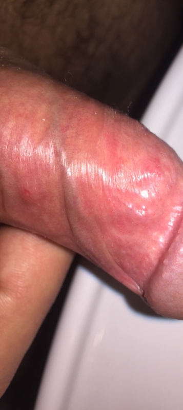Genital Herpes And Cold Sores