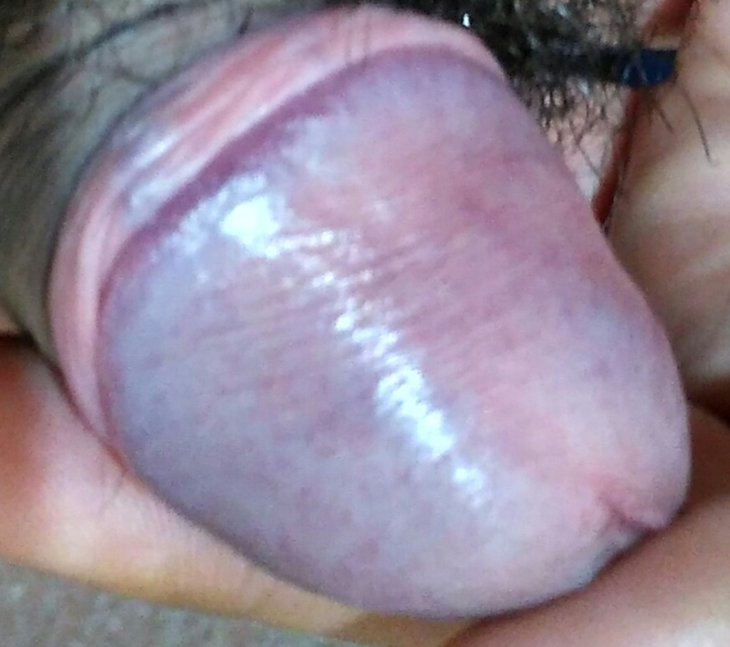 Redness On Penis After Sex 38
