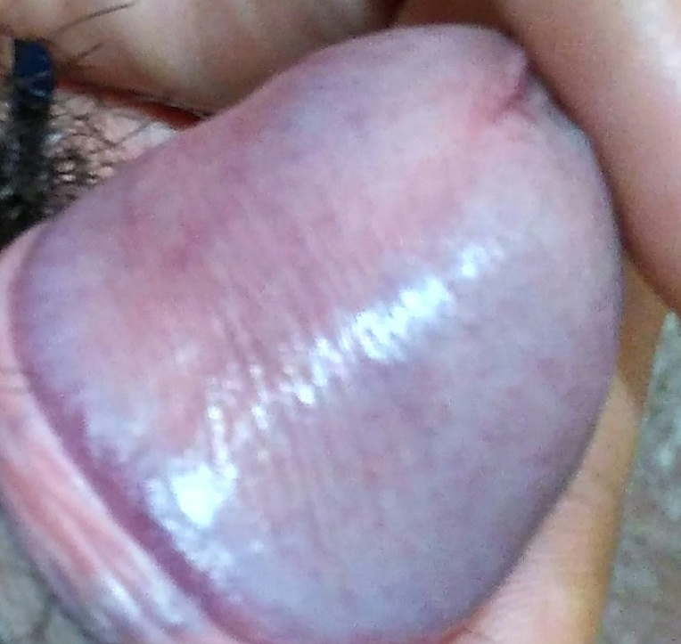 Red Glans Penis 103