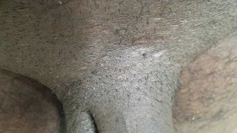 Passende Aske Stole på what are this lack marks on penis and around the penis | Sexual Health |  Forums | Patient