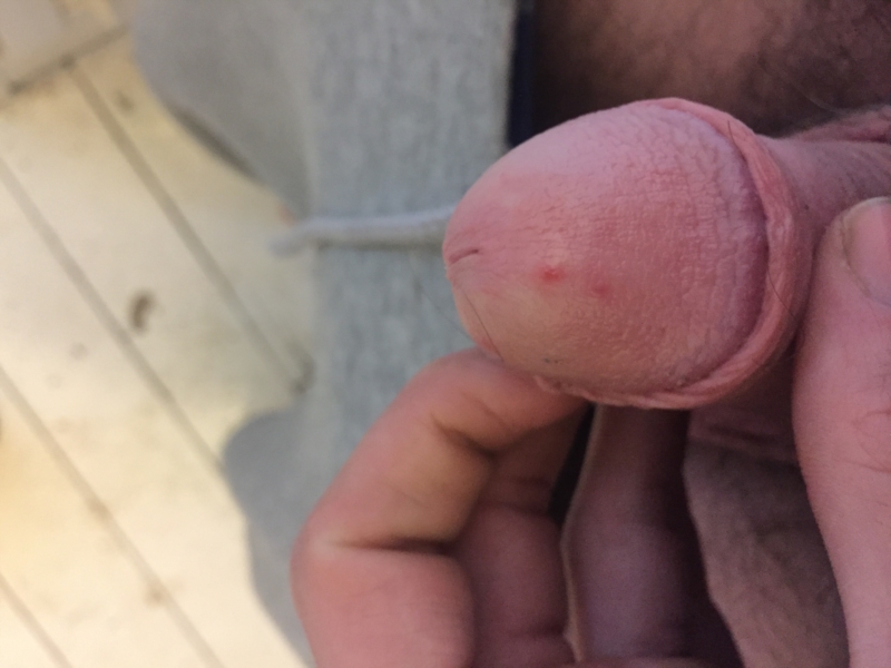 Red Spot On Tip Of Penis 30