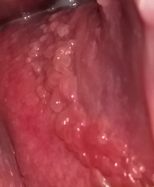 Vestibular papillomatosis compared to genital warts - Vestibular papillomatosis and warts
