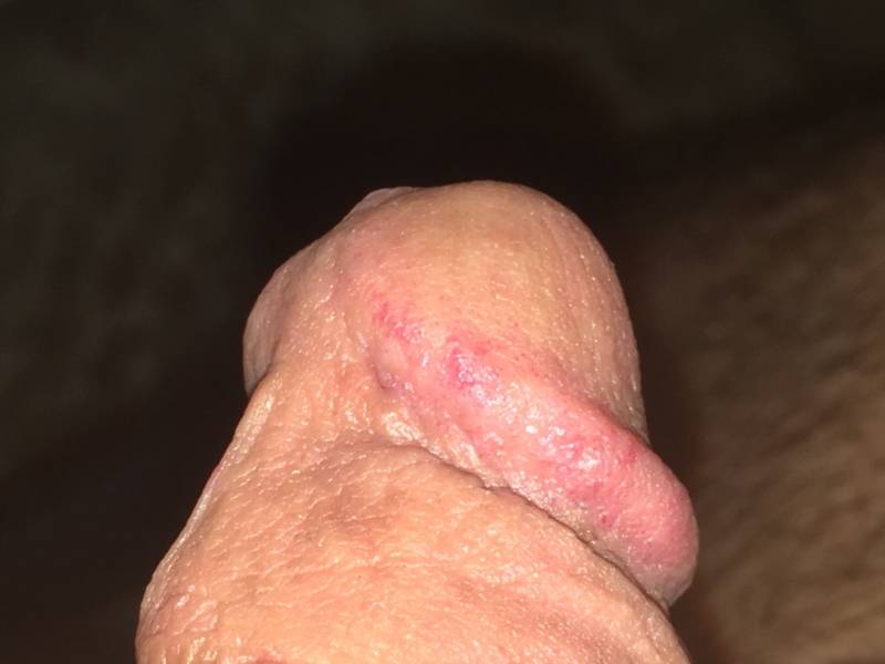 Red Spot On Penis