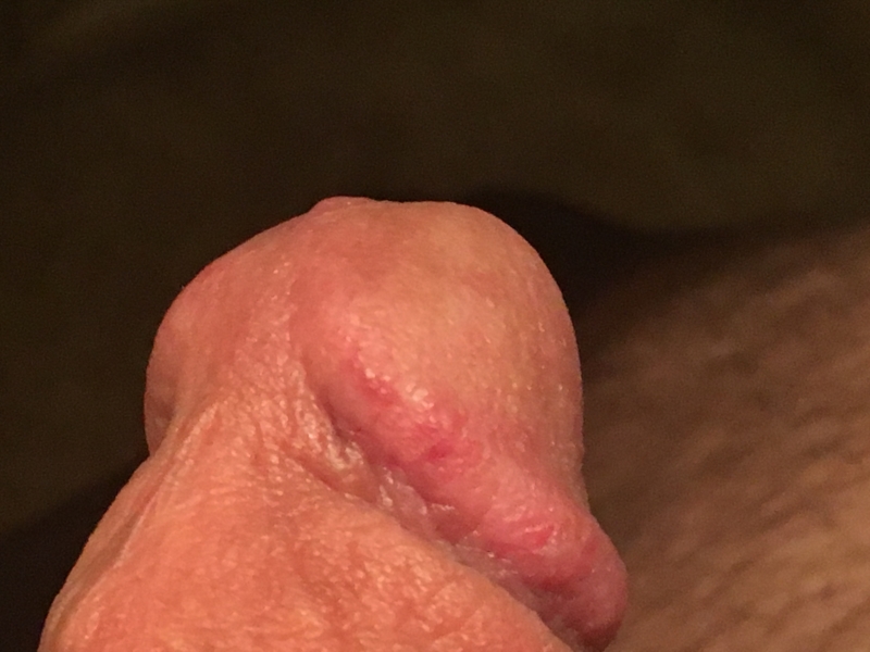 Brown Papules On The Penis