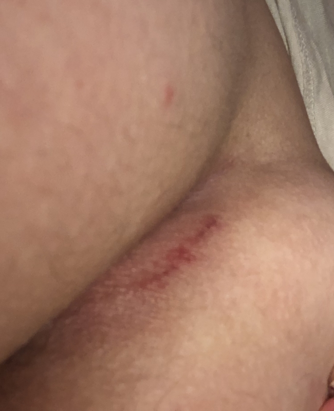 painful lump in buttock crack