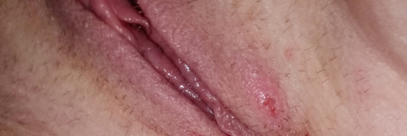 Blister Near Vagina Porn And Erotic Galleries In Hd Quality Android