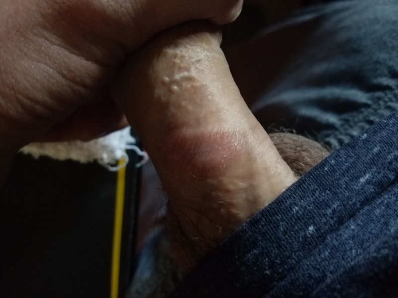 White spots on my penis