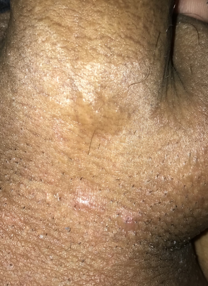 Pimple or herpes ? How to tell difference ??? | Genital Herpes Simplex |  Forums | Patient