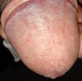 On sex after red spots penis Bumps on
