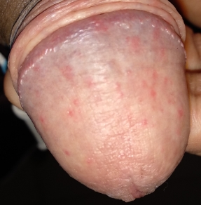 Red spots on penis no itching.