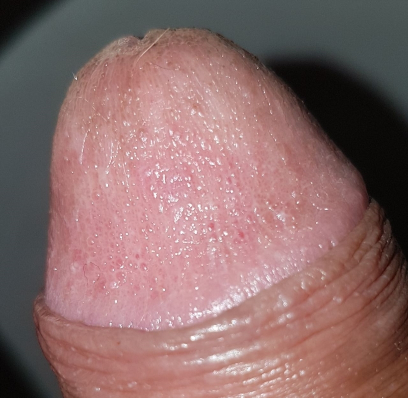 Small Bumps And Fishy Smell On Penis