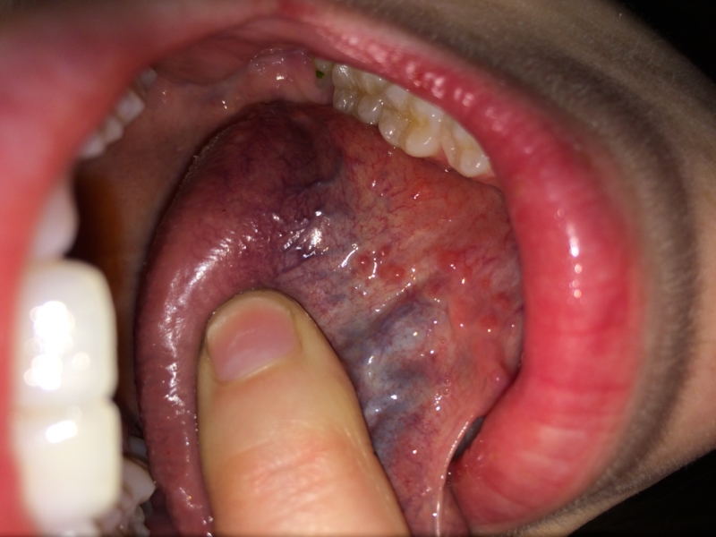 Warts on the tongue, Tongue Fibroma Removed cancere agresive
