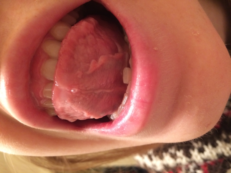 Water blister under tongue