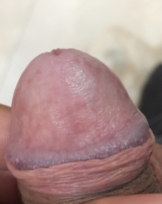 Single Silvery White Hyperkeratotic Plaque Over Glans Penis