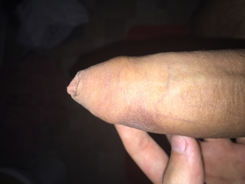 Penis Skin Peeling