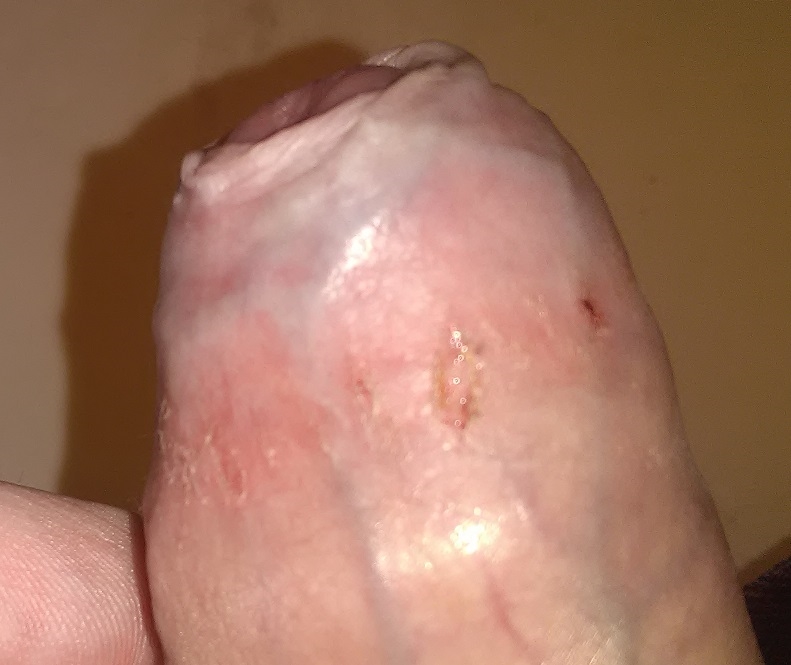 Scab On Penis.