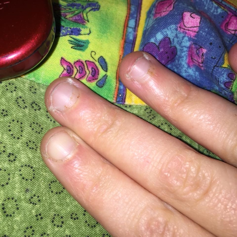 Little Brown Spots On Fingernails Design Talk