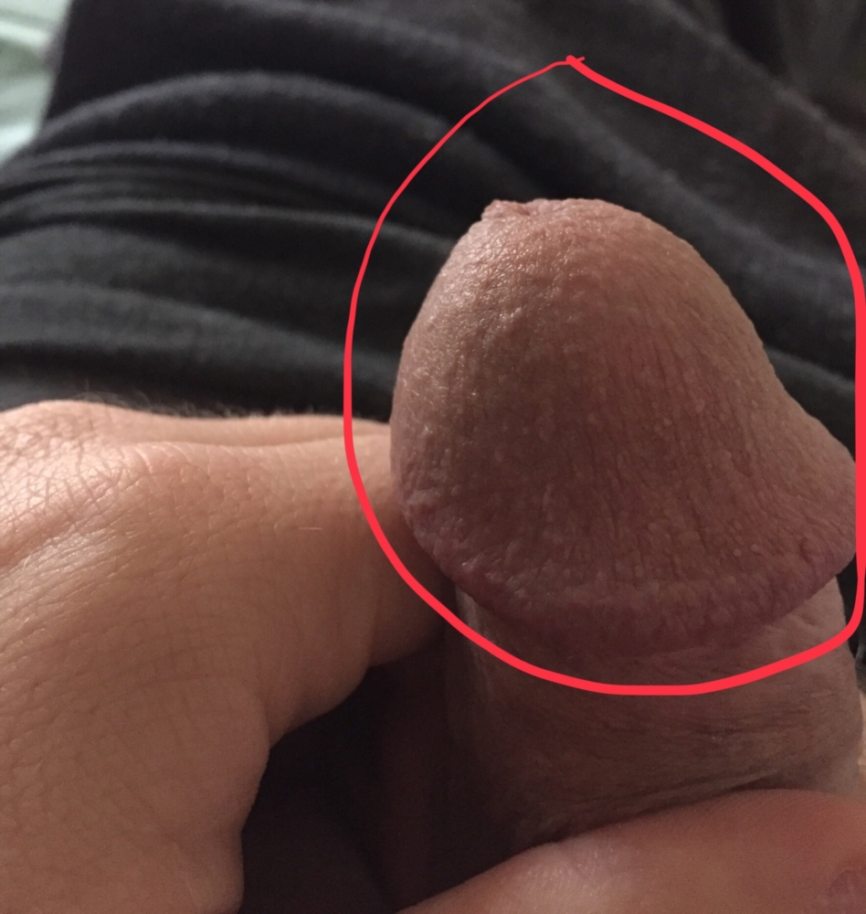 Bumps on penis head/shaft.