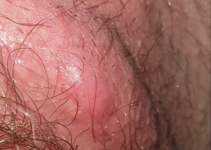 Is this herpes? 