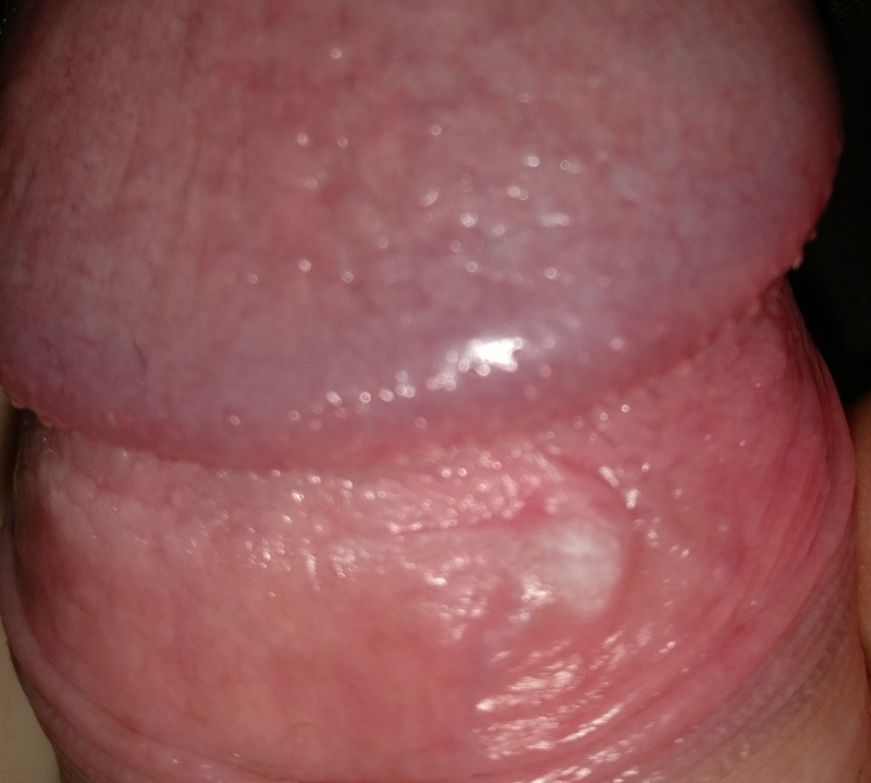 hard skin on penis - Erectile Dysfunction & Other Penis Diso. 