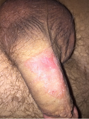 Scab on penis