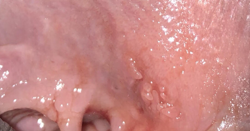 Vestibular papillomatosis and pregnancy, Vestibular papillomatosis during pregnancy