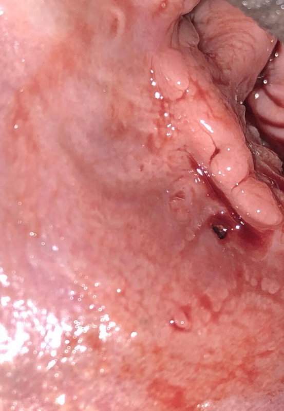 Papillomas in the nose Încărcat de Do nasal papillomas bleed - Can vestibular papillomatosis bleed
