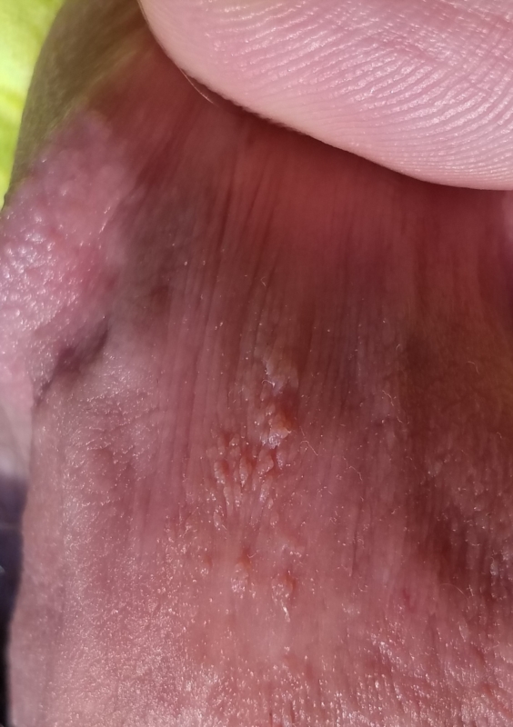 hpv wart texture sintomas de papiloma en la boca