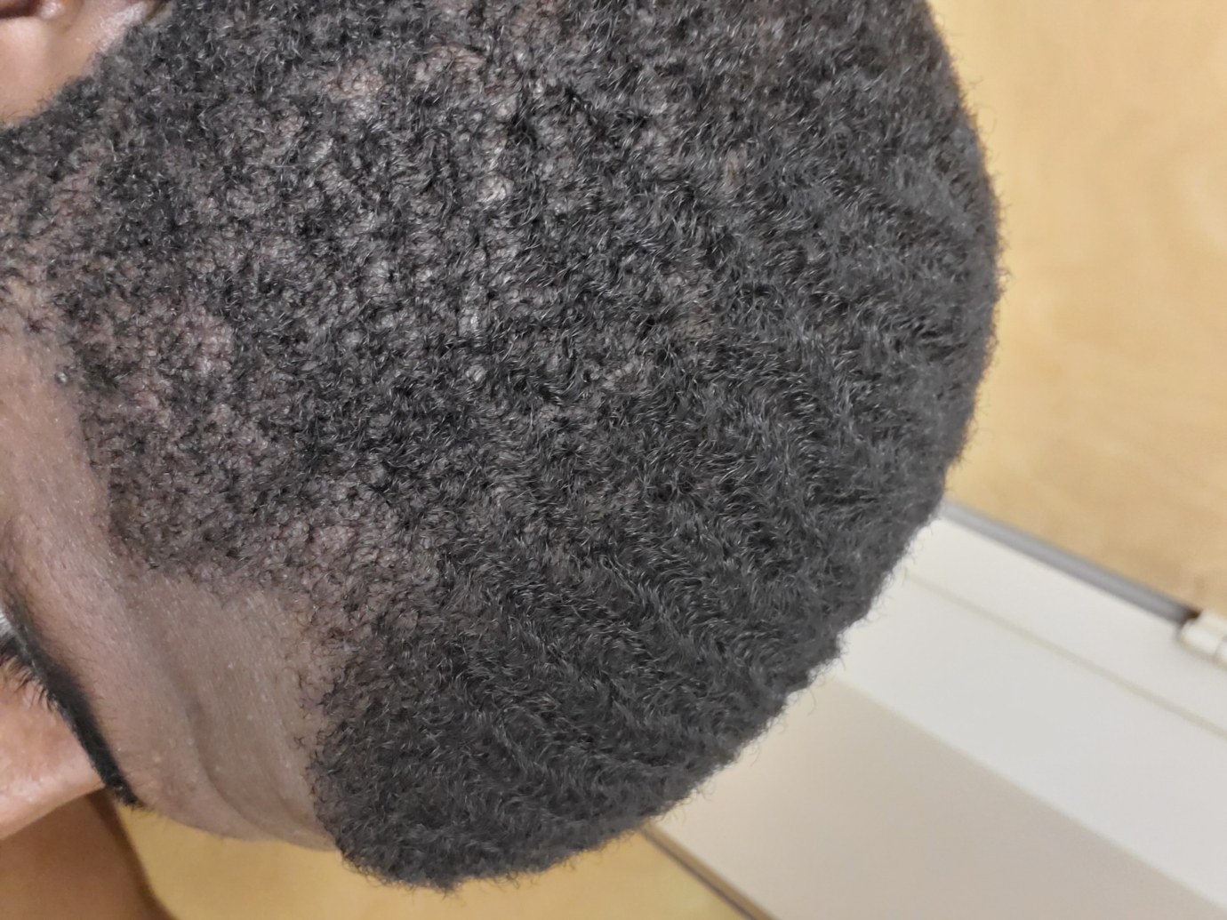 Unsure about hair loss | Alopecia and Hair Disorders | Forums | Patient