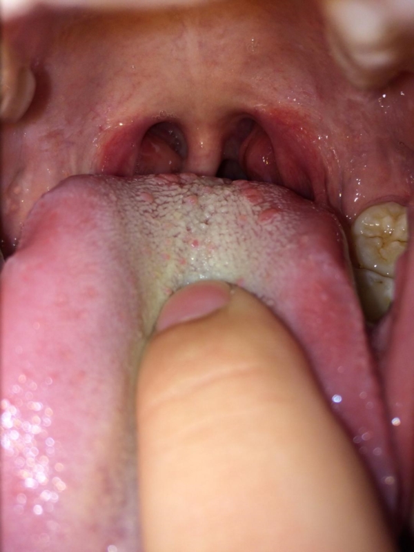 vestibular papillomatosis patient uk diferențe între negi genitale și papiloame