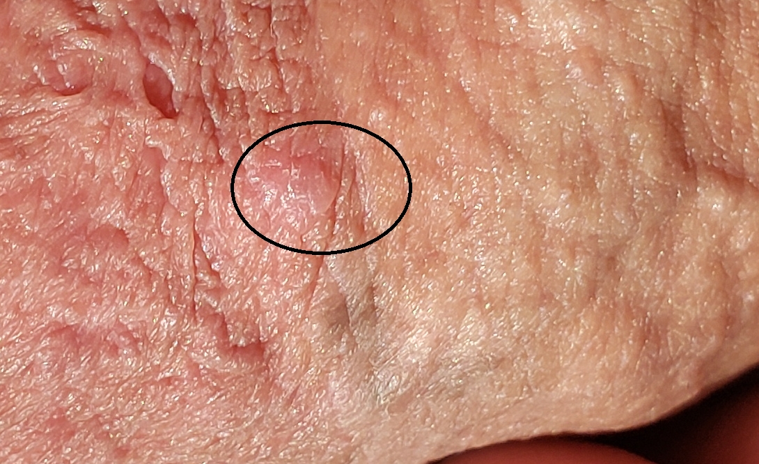 Small Flat Bump On Penis Sexual Health Forums Patient.