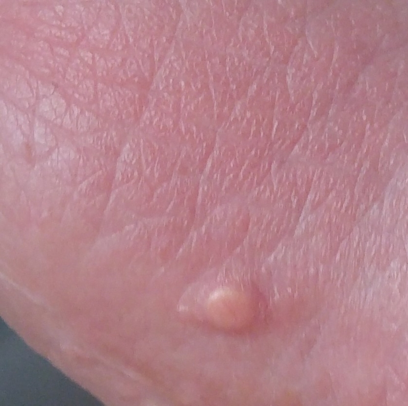 Pimples in the pennis
