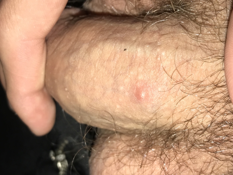 Cyst on penis
