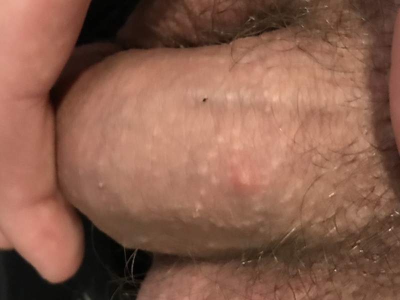 Small squashy lump on the penis