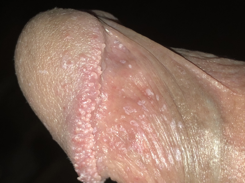 Papules vs herpes penile PPP: Pearly