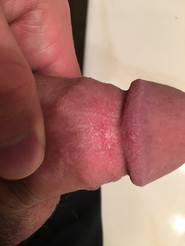 Small bump on penis head, is this from really strenuous masturbation i usua...