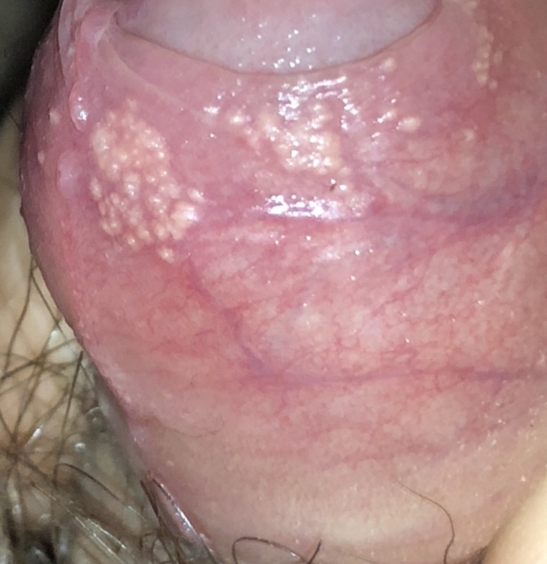 I recently noticed these scary bumps/warts on the tip of my foreskin.